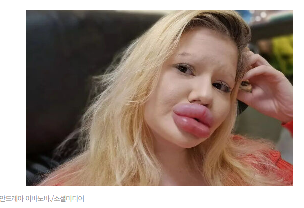 세계에서 가장 큰 입술을 가진 28살 여성