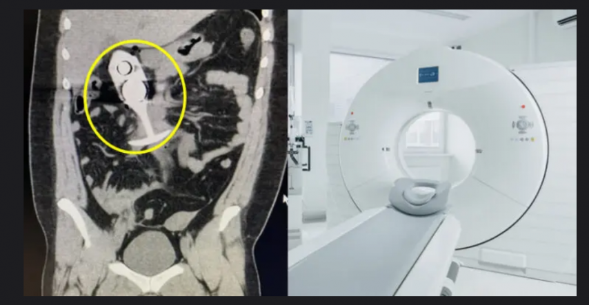 MRI 촬영 중 직장 안에 있던 성인용품 반응해 가슴까지 올라와