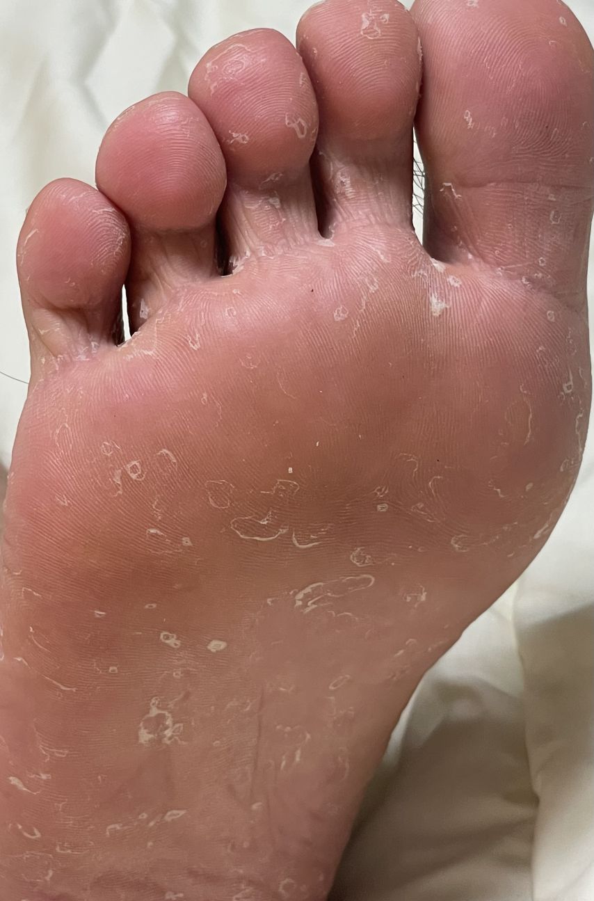 이토덕분에 드디어 무좀 완치(발사진주의)