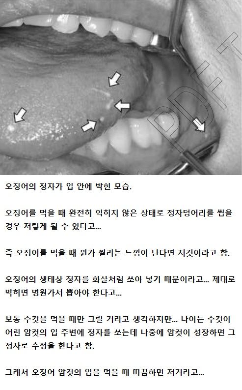 여성 입안에 박힌 정자.