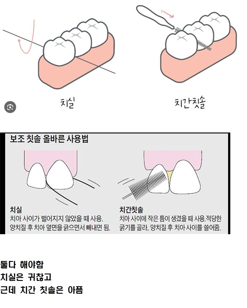 이빨 관리가 ㅈ같은 이유.