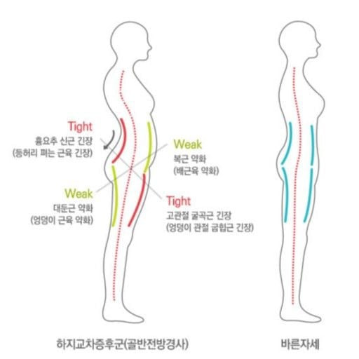 코어근육 무너진 사람 특징