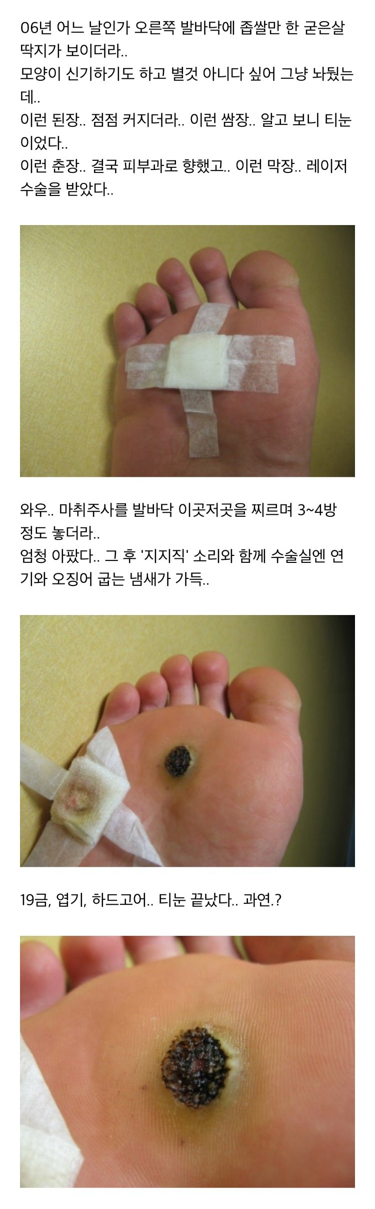 심한혐. 발바닥 티눈 제거. 스압주의.피주의.
